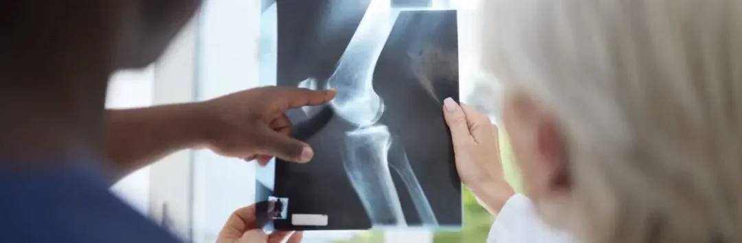 So many fractures in one bone.